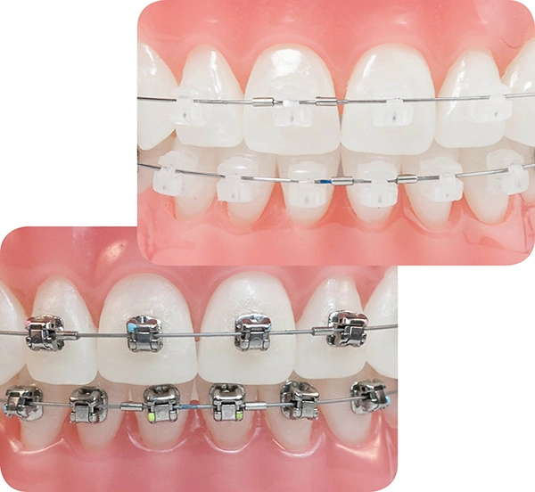 So sánh chi tiết mắc cài kim loại và mắc cài sứ 