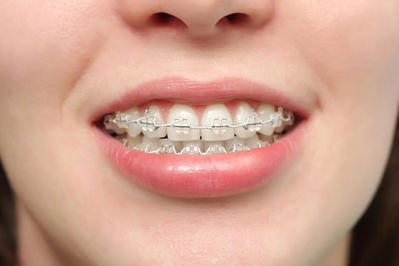 Niềng răng là phương pháp sử dụng các khí cụ chỉnh nha như mắc cài, dây cung, khay trong suốt