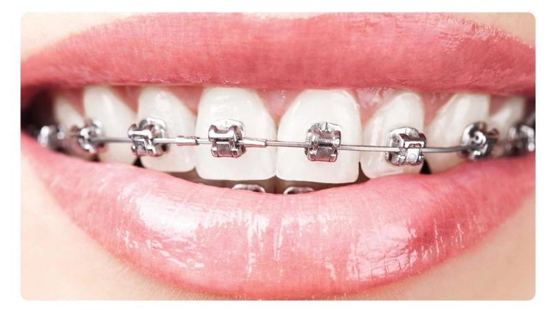 niềng răng mắc cài tự buộc