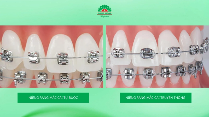 niềng răng mắc cài tự buộc