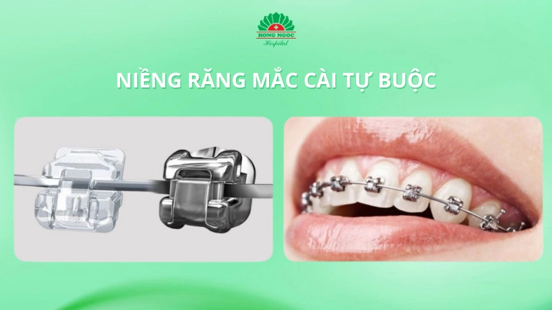 niềng răng mắc cài tự buộc