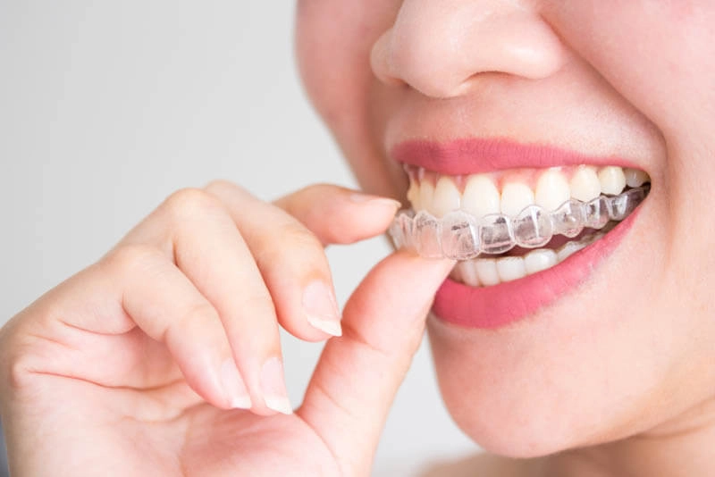 Các phương pháp niềng răng ở người trưởng thành