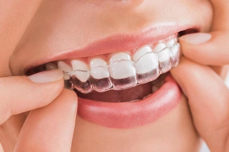 niềng răng trong suốt invisalign