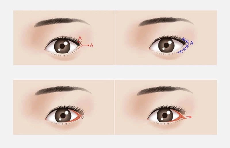 phân biệt mở góc mắt