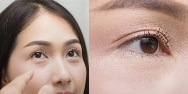 Hình ảnh Cắt bọng mắt đường mi dưới