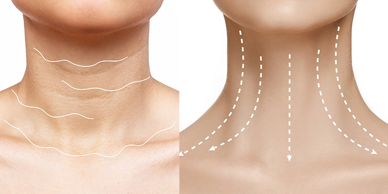 Ai nên thực hiện căng da cổ?