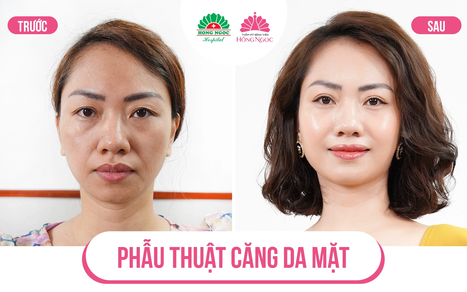 Ưu, nhược điểm của phẫu thuật căng da mặt