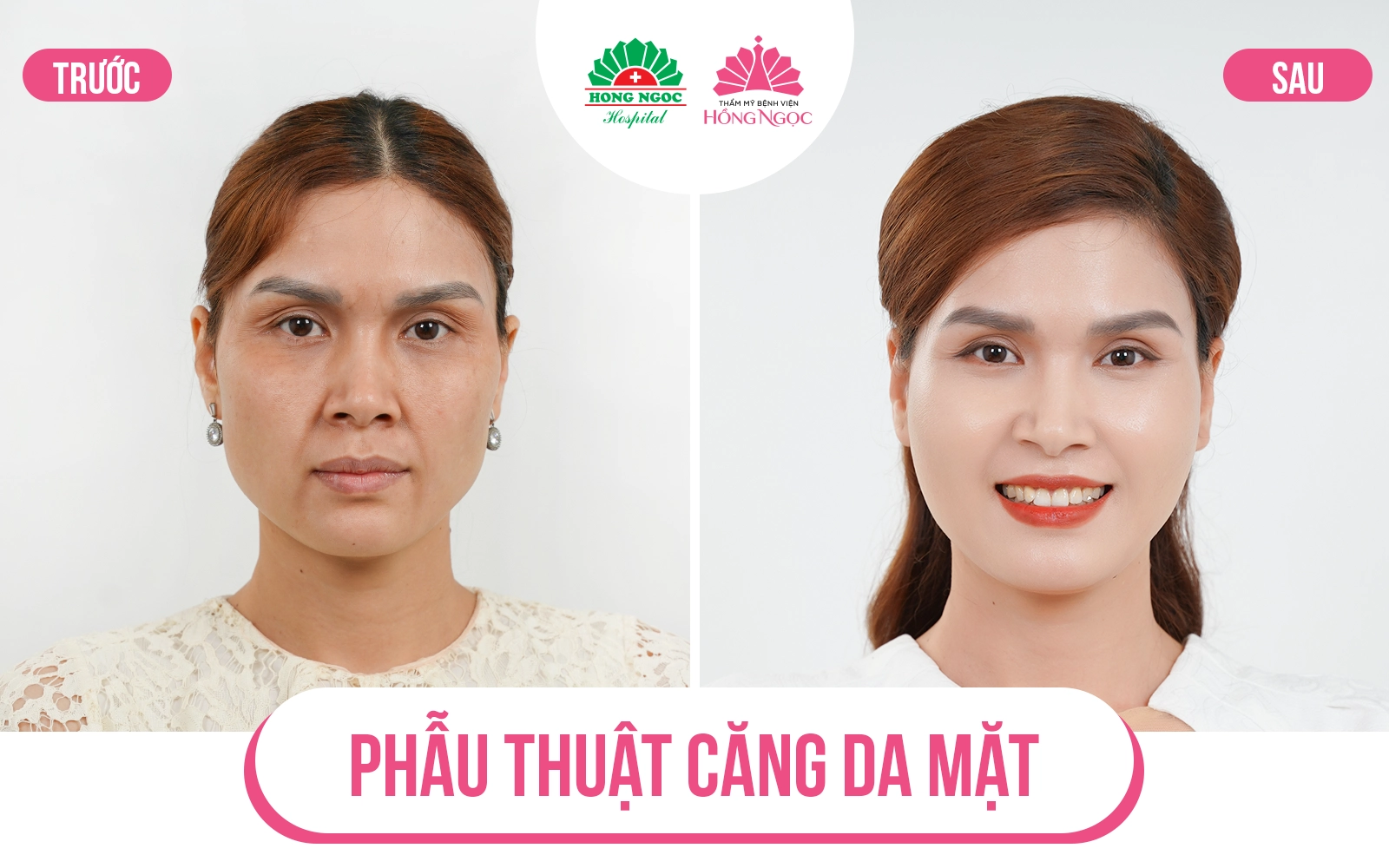 Quy trình thực hiện phẫu thuật căng da mặt tại Thẩm mỹ Bệnh viện Hồng Ngọc