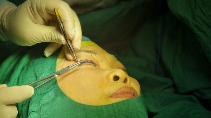 phẫu thuật mí mắt là gì