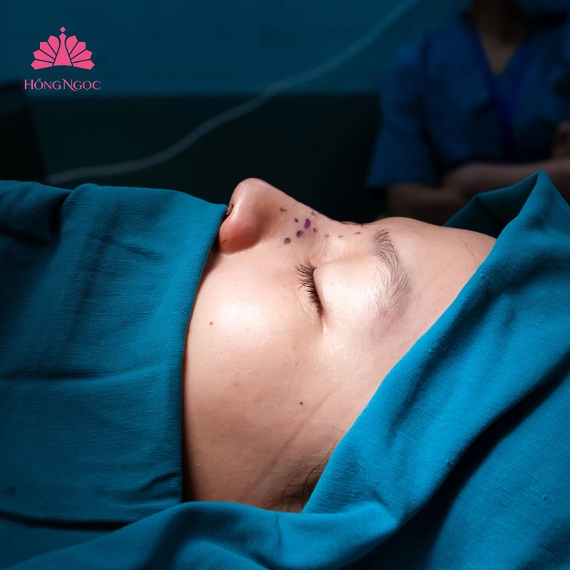 phẫu thuật chỉnh mũi lệch