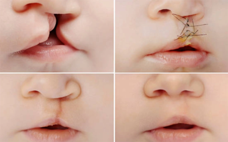 Khi nào trẻ có thể phẫu thuật khe hở môi - vòm miệng?