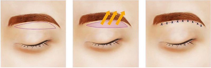 phau-thuat-nang-cung-chan-may