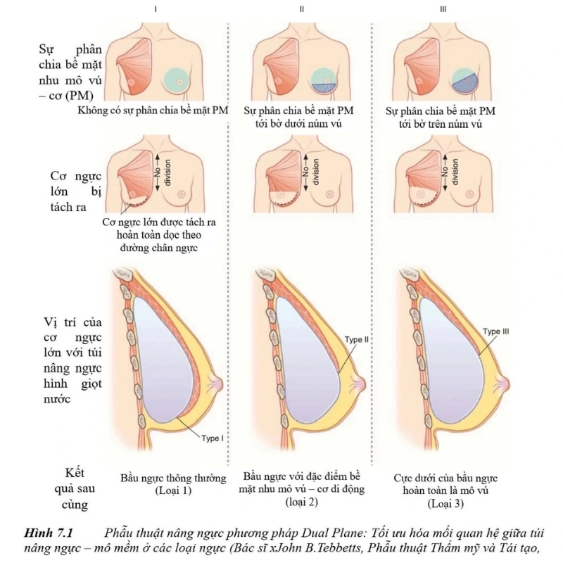 Phẫu thuật nâng ngực là phương pháp phẫu thuật thẩm mỹ giúp làm tăng kích thước, cải thiện hình dáng của vòng 1
