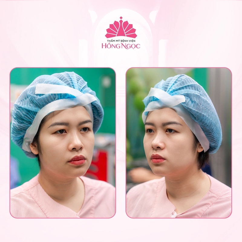 phẫu thuật sụp mí mắt