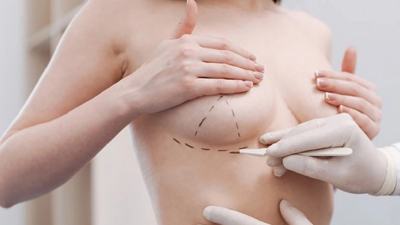 phẫu thuật ngực phì đại có ghép quầng vú