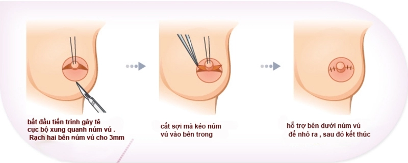 phẫu thuật tụt núm vú 