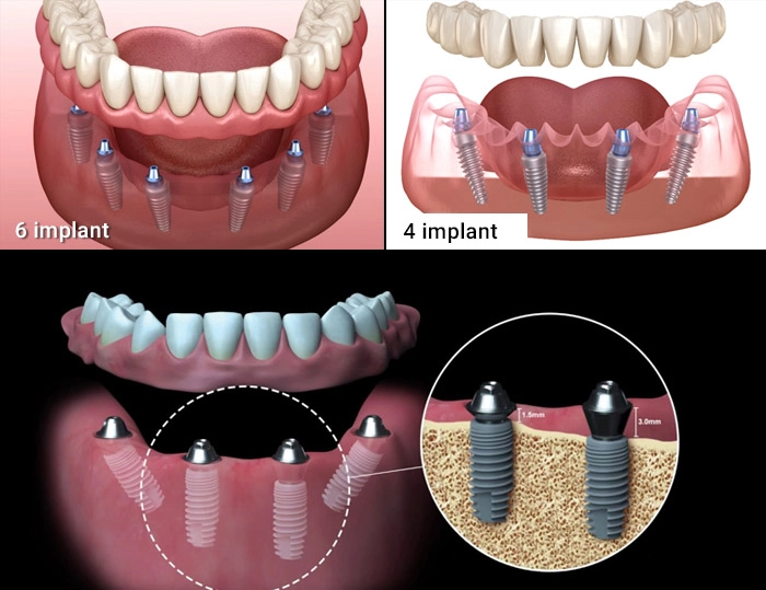 Vì sao cần lựa chọn địa chỉ trồng răng Implant uy tín?