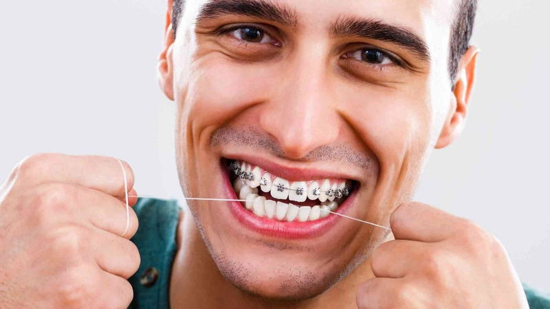 phương pháp niềng răng cho người lớn