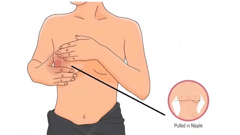 phẫu thuật tụt núm vú