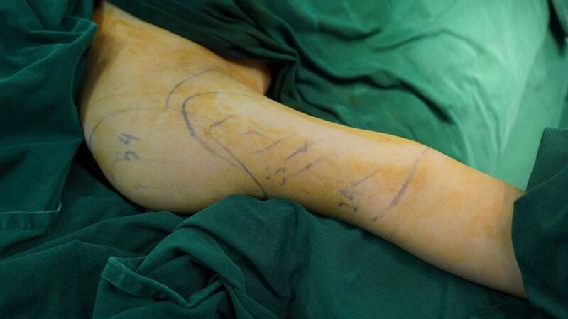 quy trình hút mỡ bắp tay