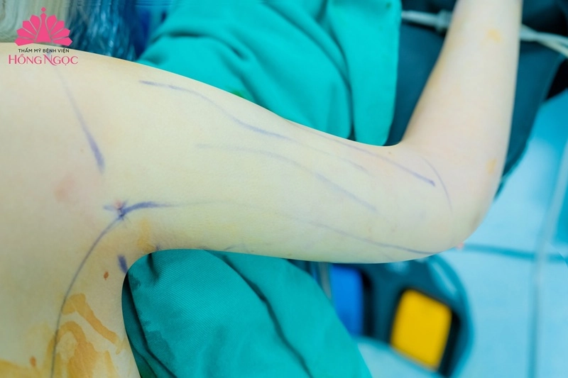 quy trình hút mỡ bắp tay