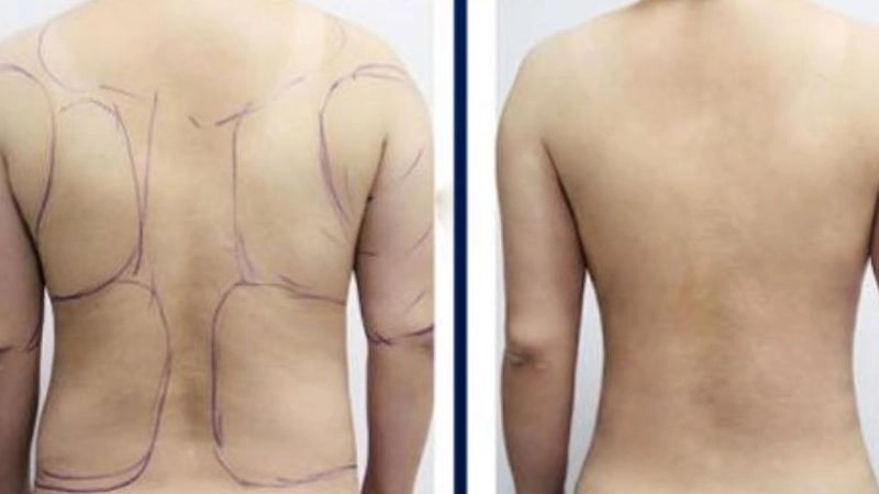 quy trình hút mỡ lưng