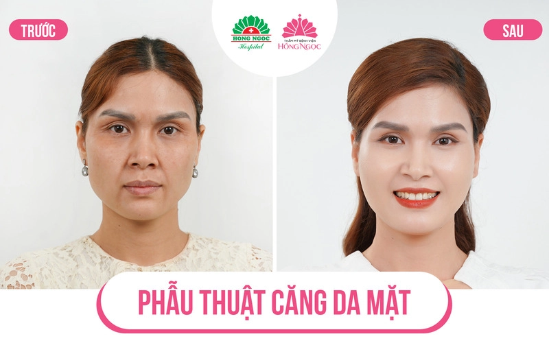 quy trình phẫu thuật căng da mặt