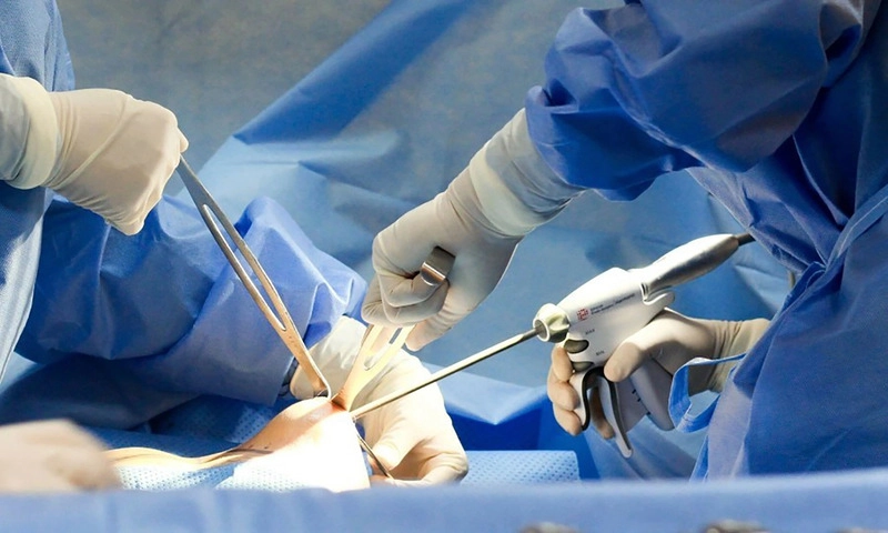 quy trình phẫu thuật treo sa trễ đường quầng