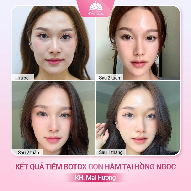 quy trình tiêm botox gọn hàm