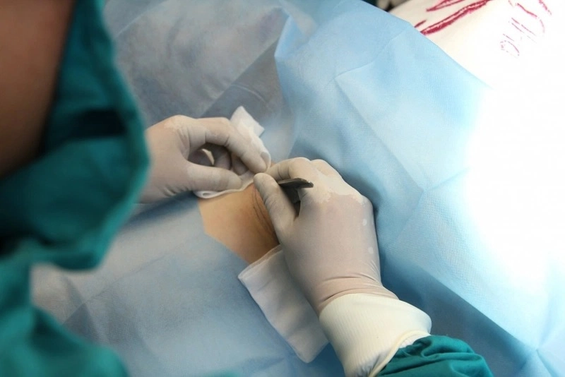 quy trình tiêm botox trị hôi nách