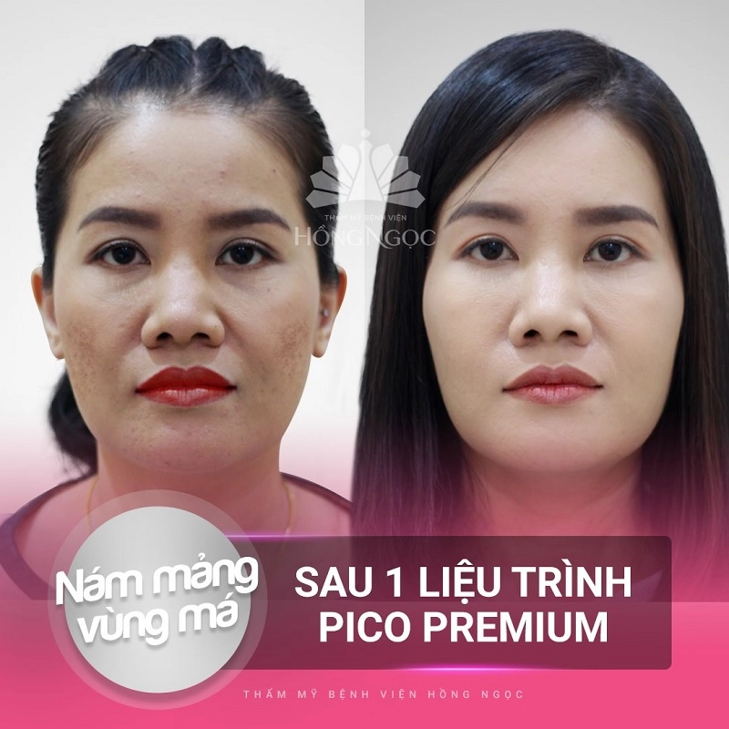 quy trình trị nám chuẩn y khoa