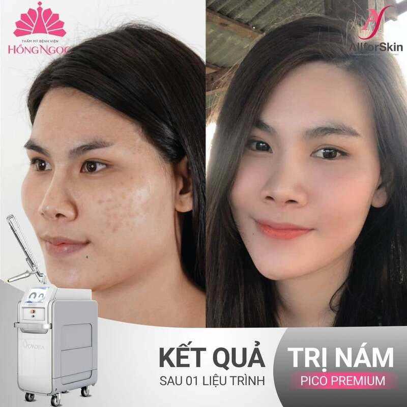 quy trình trị nám tại hồng ngọc