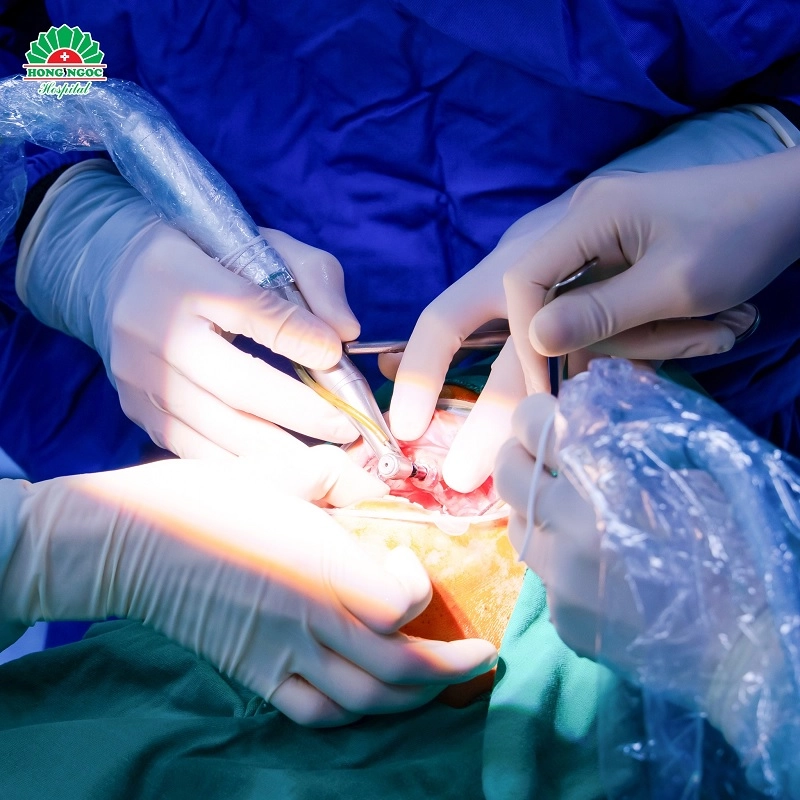 quy trình trồng răng implant