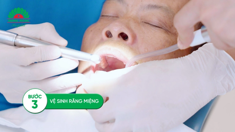 quy trình trồng răng Implant