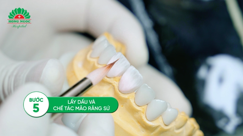quy trình trồng răng Implant