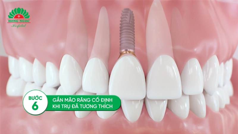 quy trình trồng răng Implant