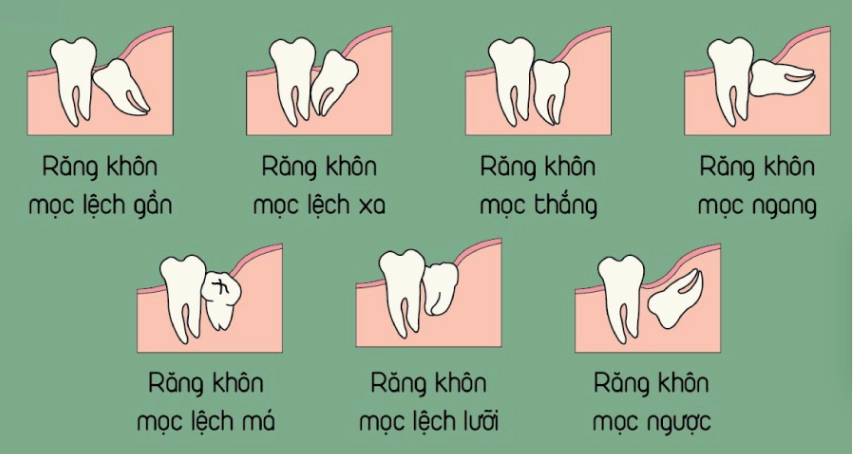 Có nên nhổ răng khôn mọc lệch, mọc ngầm không?