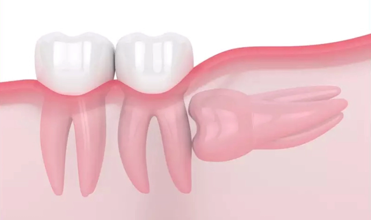 Dấu hiệu răng khôn mọc ngầm, mọc lệch