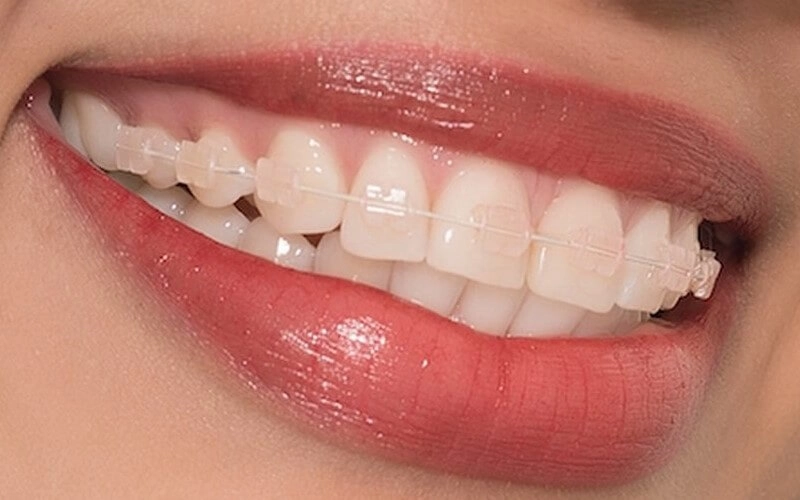 Nhược điểm của niềng răng mắc cài sứ