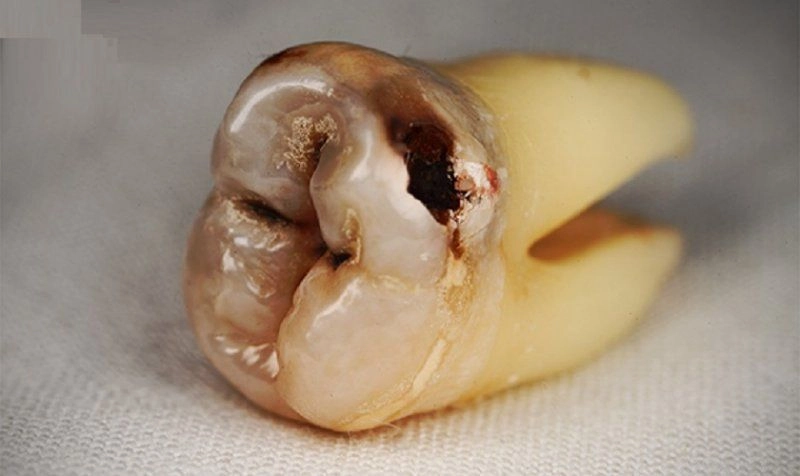 tình trạng răng số 8 bị sâu vỡ