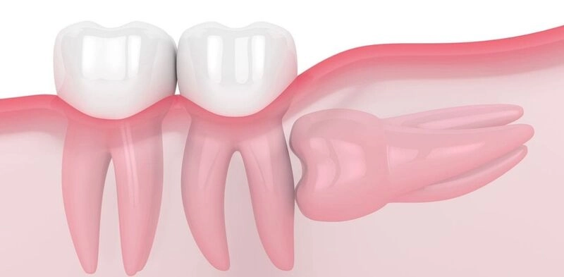 răng số 8 mọc ngang là gì