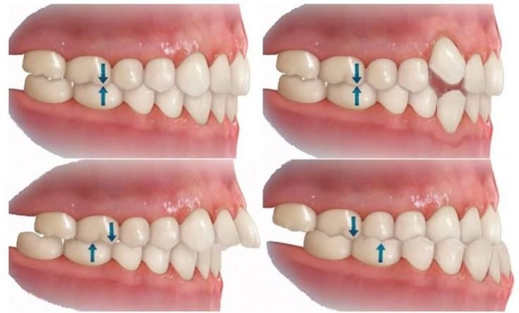 Sai khớp cắn là gì?