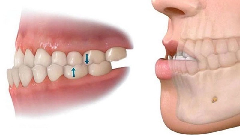 Các phương pháp điều trị sai khớp cắn