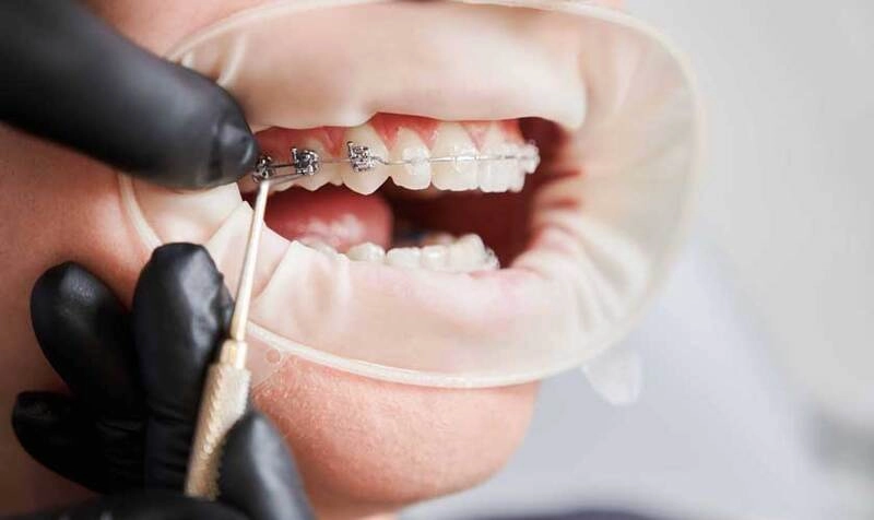 sâu răng có niềng được răng không