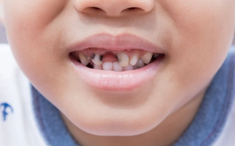 Các dấu hiệu sâu răng ở trẻ em