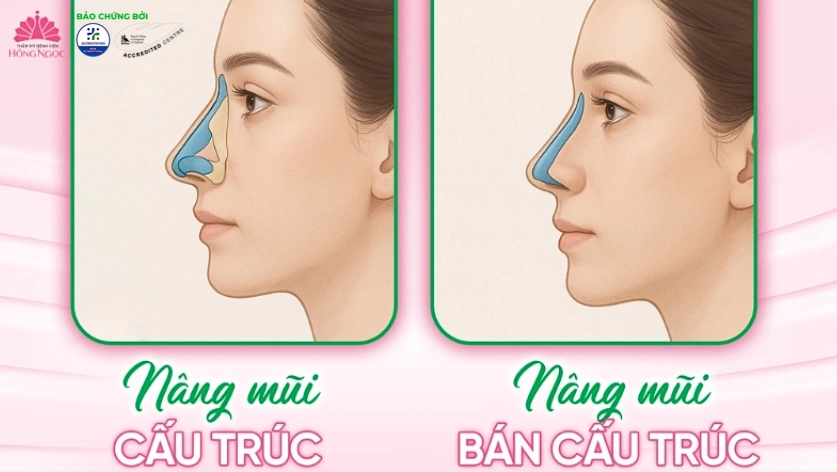 Nâng mũi Hàn Quốc