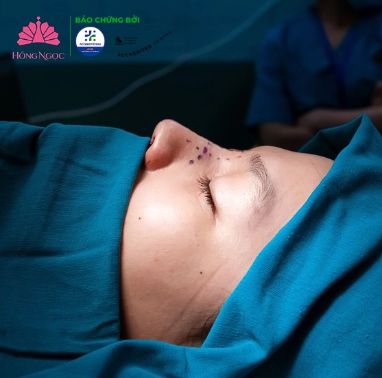 phẫu thuật chỉnh mũi lệch tại Hồng Ngọc