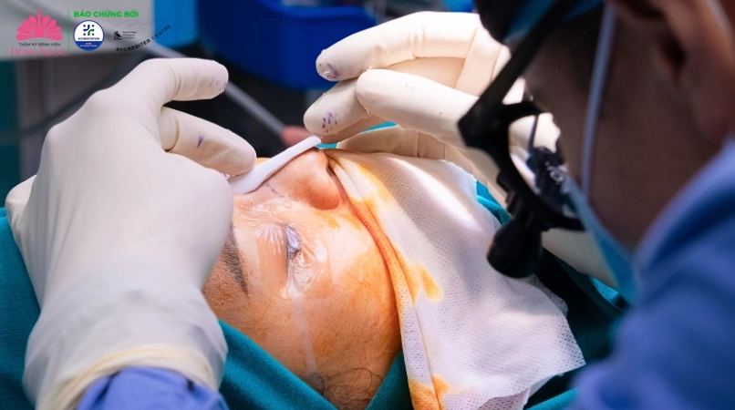 Nâng mũi tại Thẩm mỹ Bệnh viện Hồng Ngọc