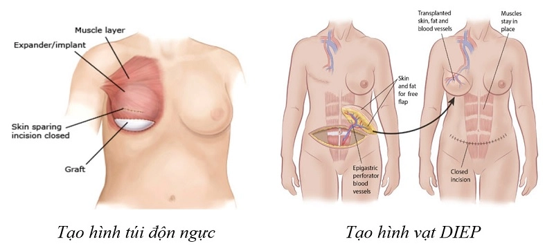 so sánh tái tạo vú bằng vạt da bụng và túi độn ngực