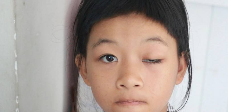 sụp mí mắt bẩm sinh